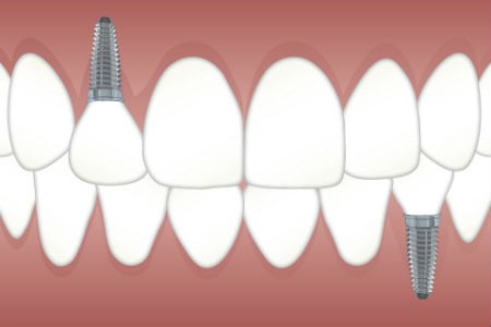 Tipos de implantes dentales